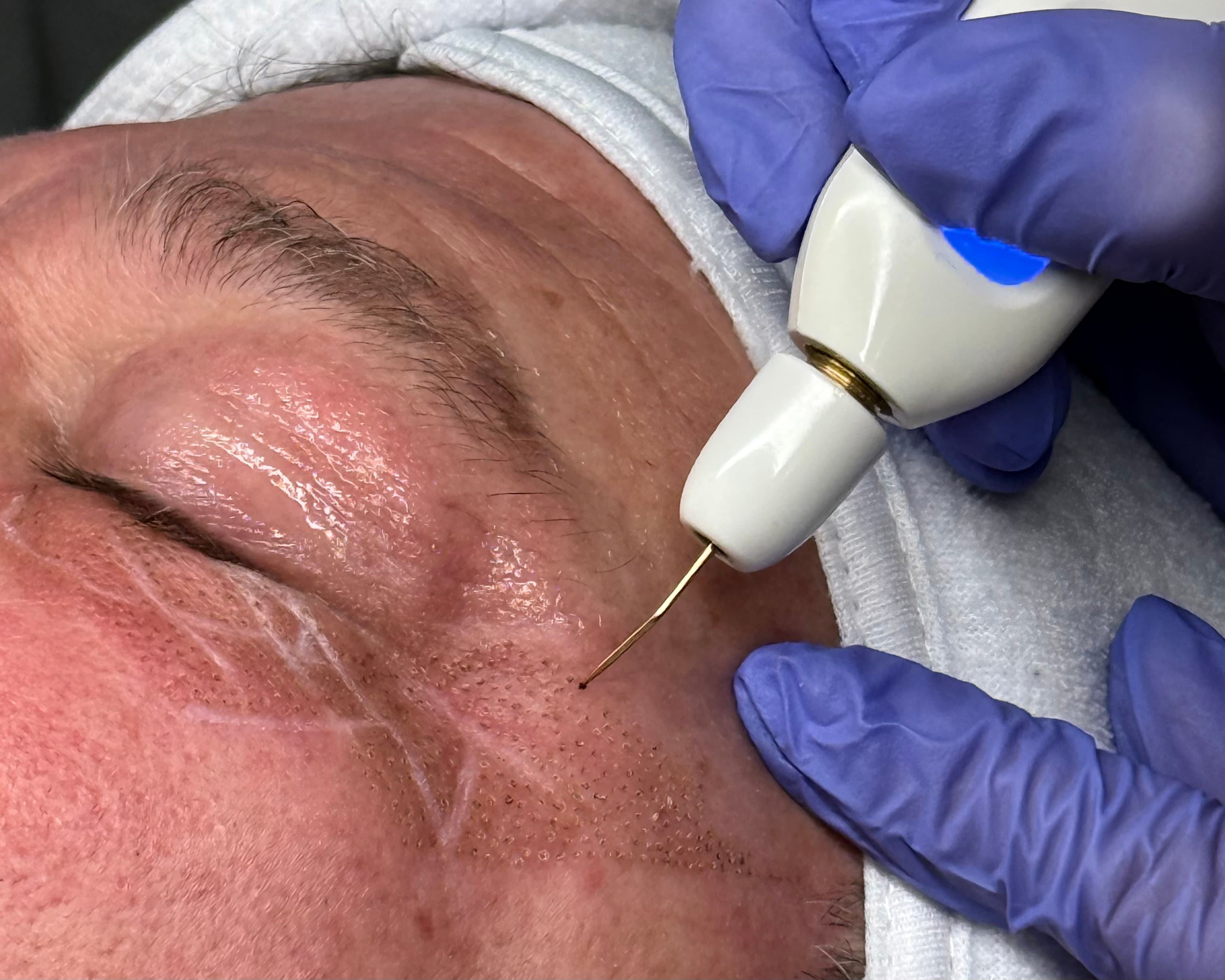 Rajeunissement et lifting non invasif